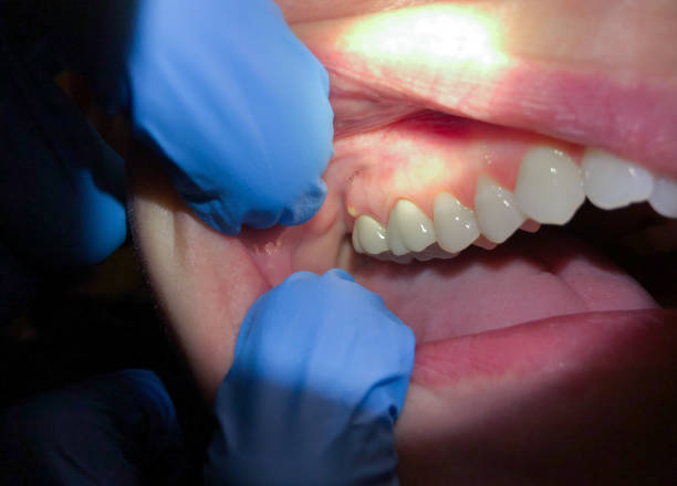 Best Emergency Wisdom Tooth Extraction in Scottsville, KY